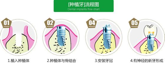 牙齿缺了好几颗怎么修复