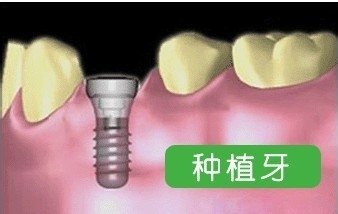 为什么国外把种植牙作为修复缺牙的方式？
