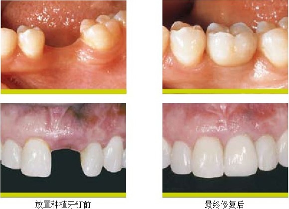 需要满足哪些条件才可以做即刻种植牙？