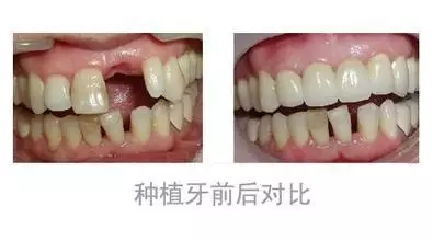 不宜做种植牙的症状