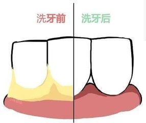 洗牙后牙缝变大会自动恢复吗