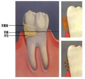 口臭检查和治疗的大概费用
