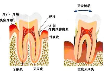 牙结石可以保护牙齿吗
