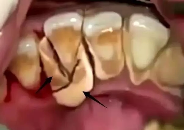 一个人长期抽烟，不注意口腔清洁，10年会怎么样