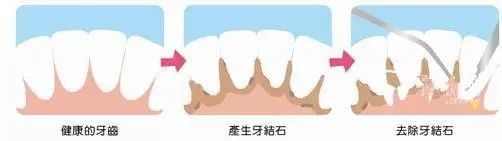 想去洗牙，担心洗牙有什么坏处