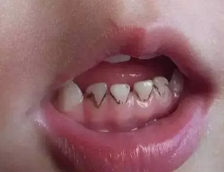 儿童有必要洗牙吗，有没有危害?
