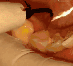 洗牙去除牙结石