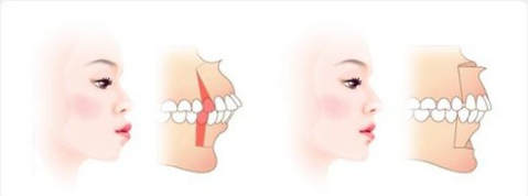 爱康健口腔医院隐形矫正