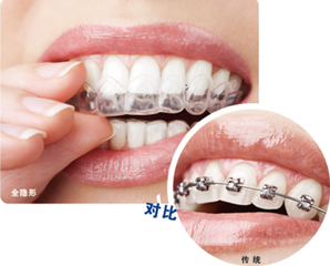 隐形矫正的步骤和流程是怎样的？