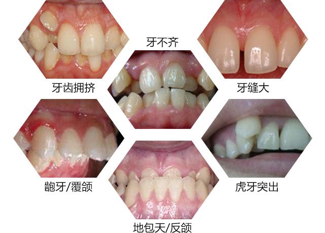 18以后戴牙套矫正牙齿还有用吗