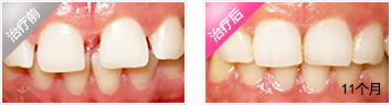 牙齿矫正后反弹的原因