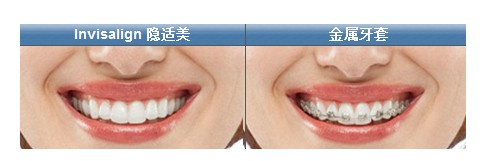 牙齿矫正期需要做好清洁