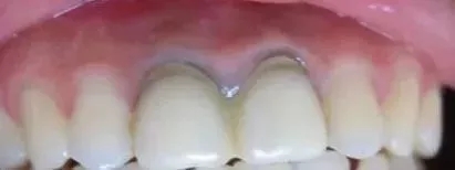 烤瓷牙