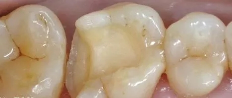 补牙