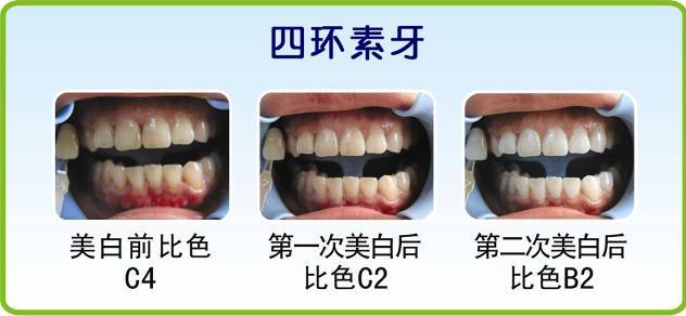 四环素牙是怎样形成的
