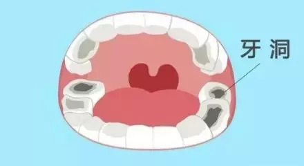 龋齿