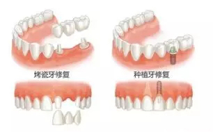 烤瓷冠
