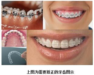 青少年牙齿矫正选择什么牙套好