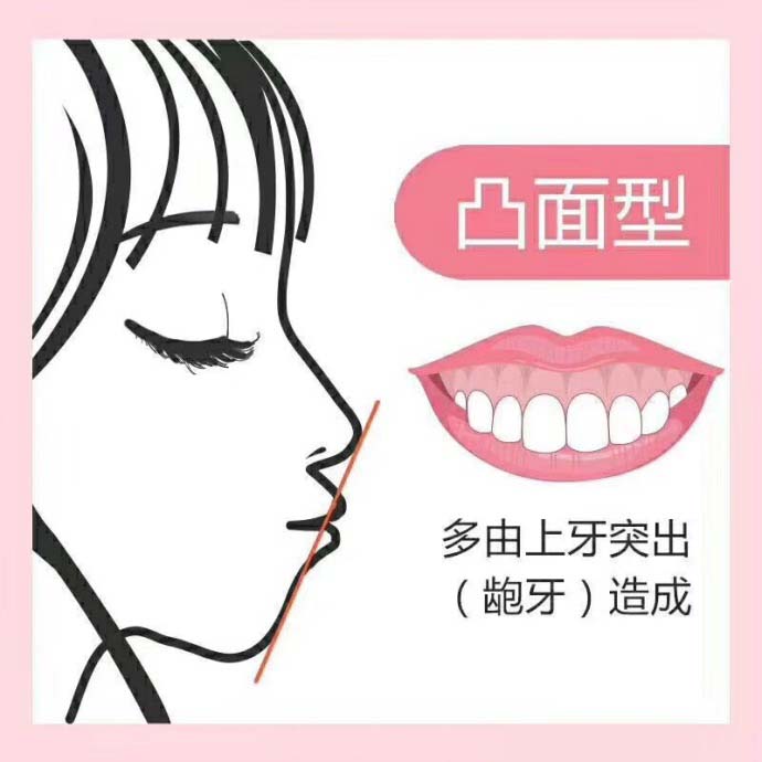 牙齿整齐就有点翘,想窟牙，效果好吗