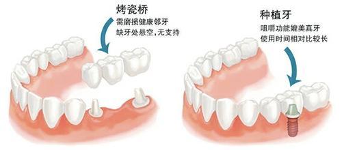 镶牙和种牙的不同点
