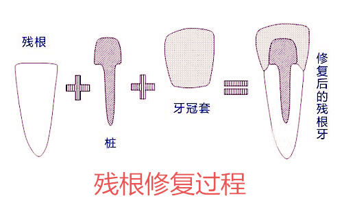 车祸掉牙剩牙根，种植牙和打桩哪个好