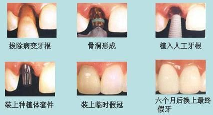 是否可以做种植牙，大家需要知道以下几点