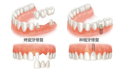 种植牙和烤瓷牙有什么区别