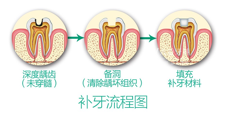 补牙