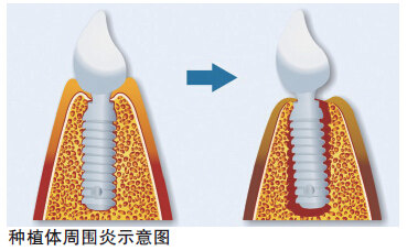 整个种植牙完成需要多久时间