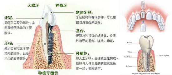 种植牙结构介绍