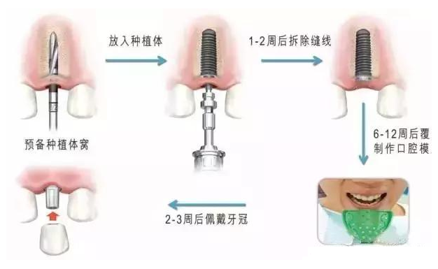 做种植牙要多长时间