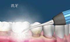 牙结石要如何清除呢？