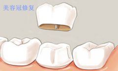 柳州美容冠的修复治疗好用吗